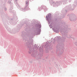 Analysing the microbiome of gFOB samples could improve accuracy of screening in 